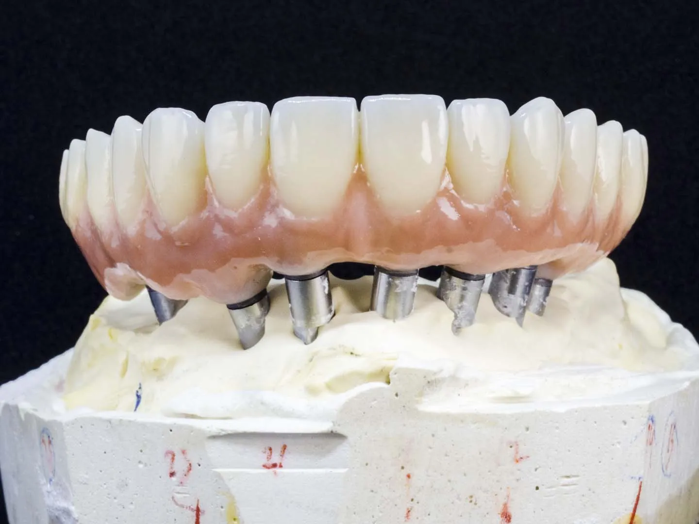 Implant overdentures at Gentle Dental